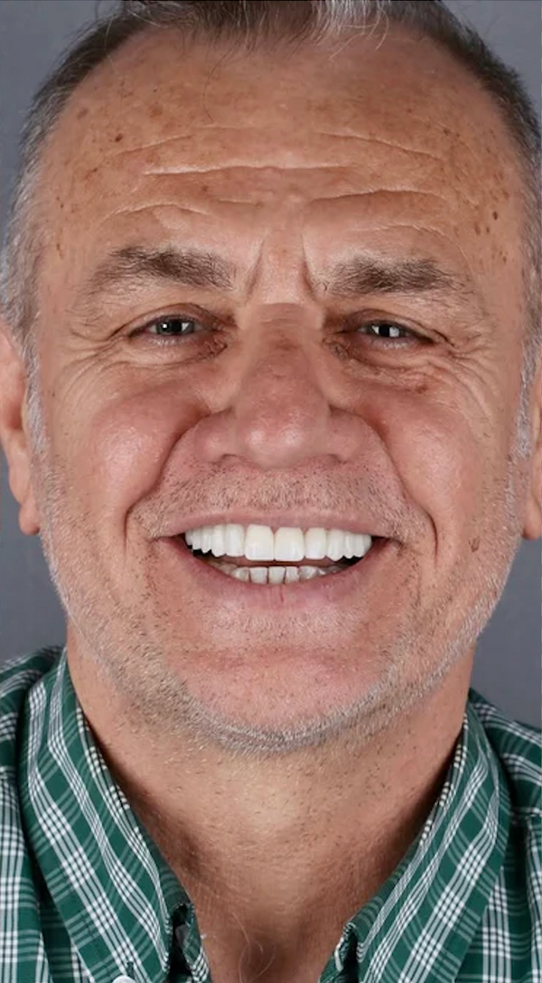 Después de usar Lumina